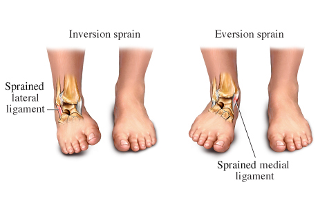 ankle sprains