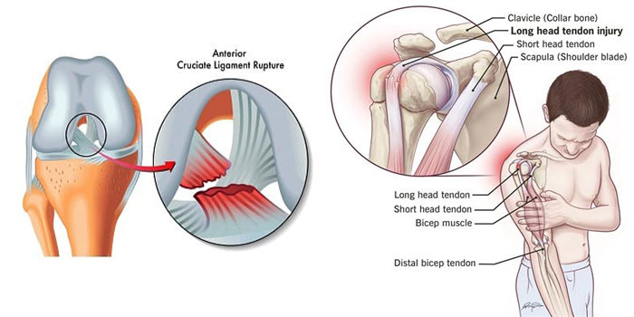ligament injury