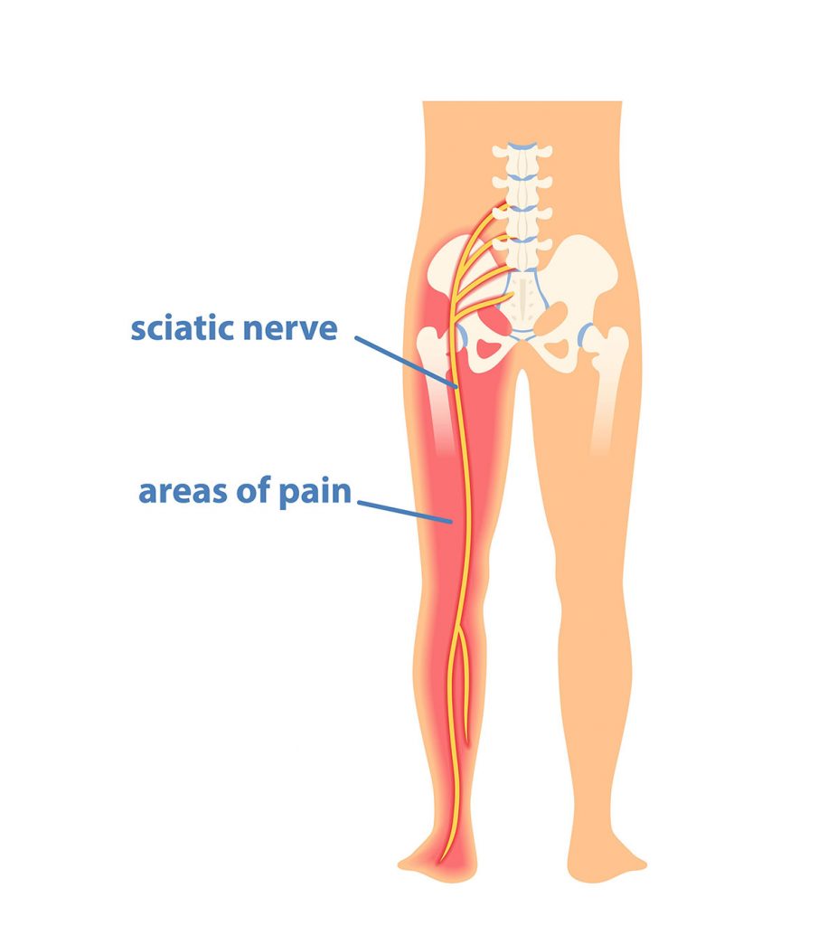 sciatic nerve 926x1024
