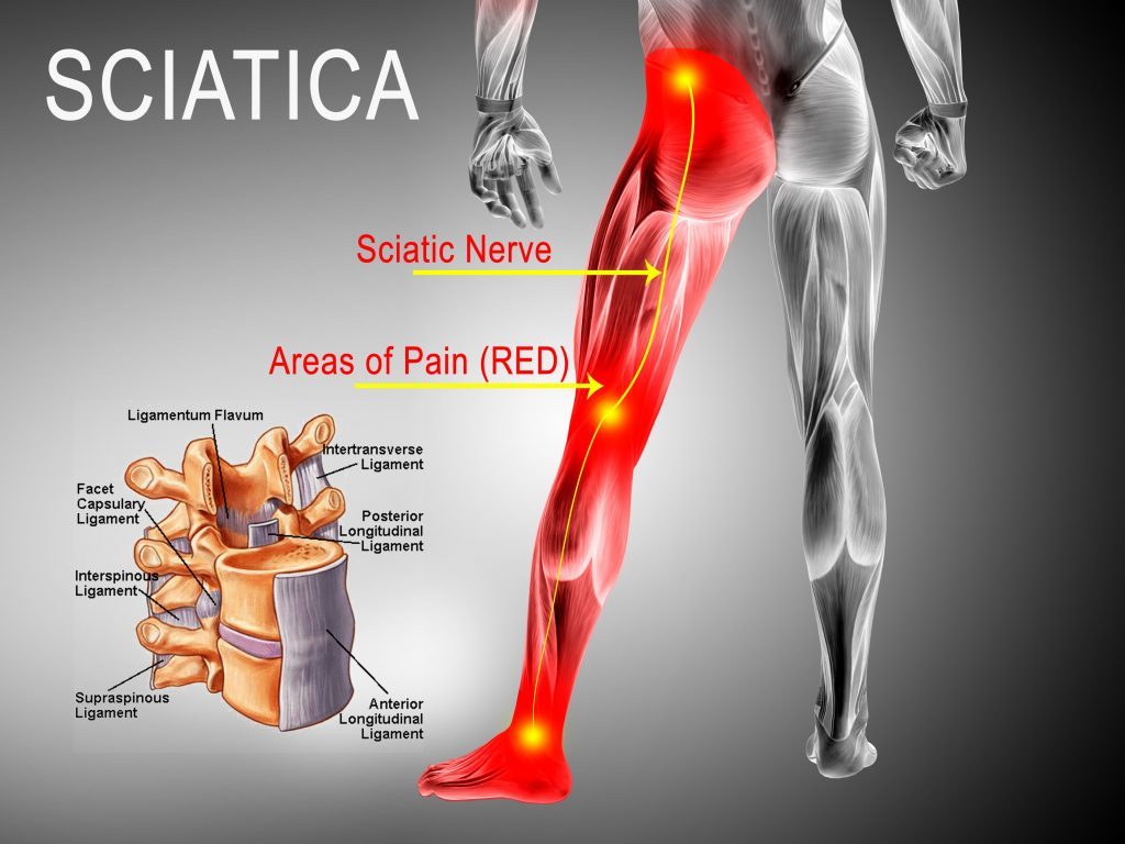 sciatica pain colorado pain care blog 1024x768